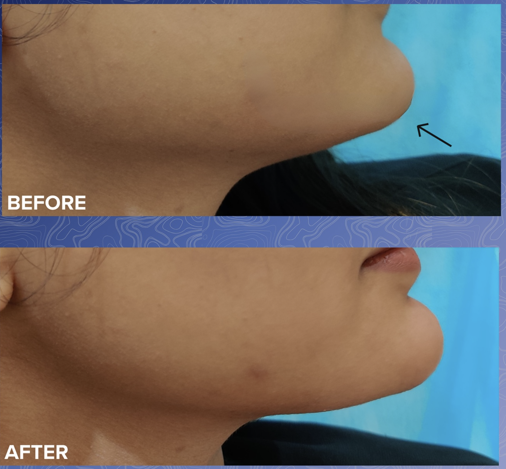 Jawline Filler Before & After 1