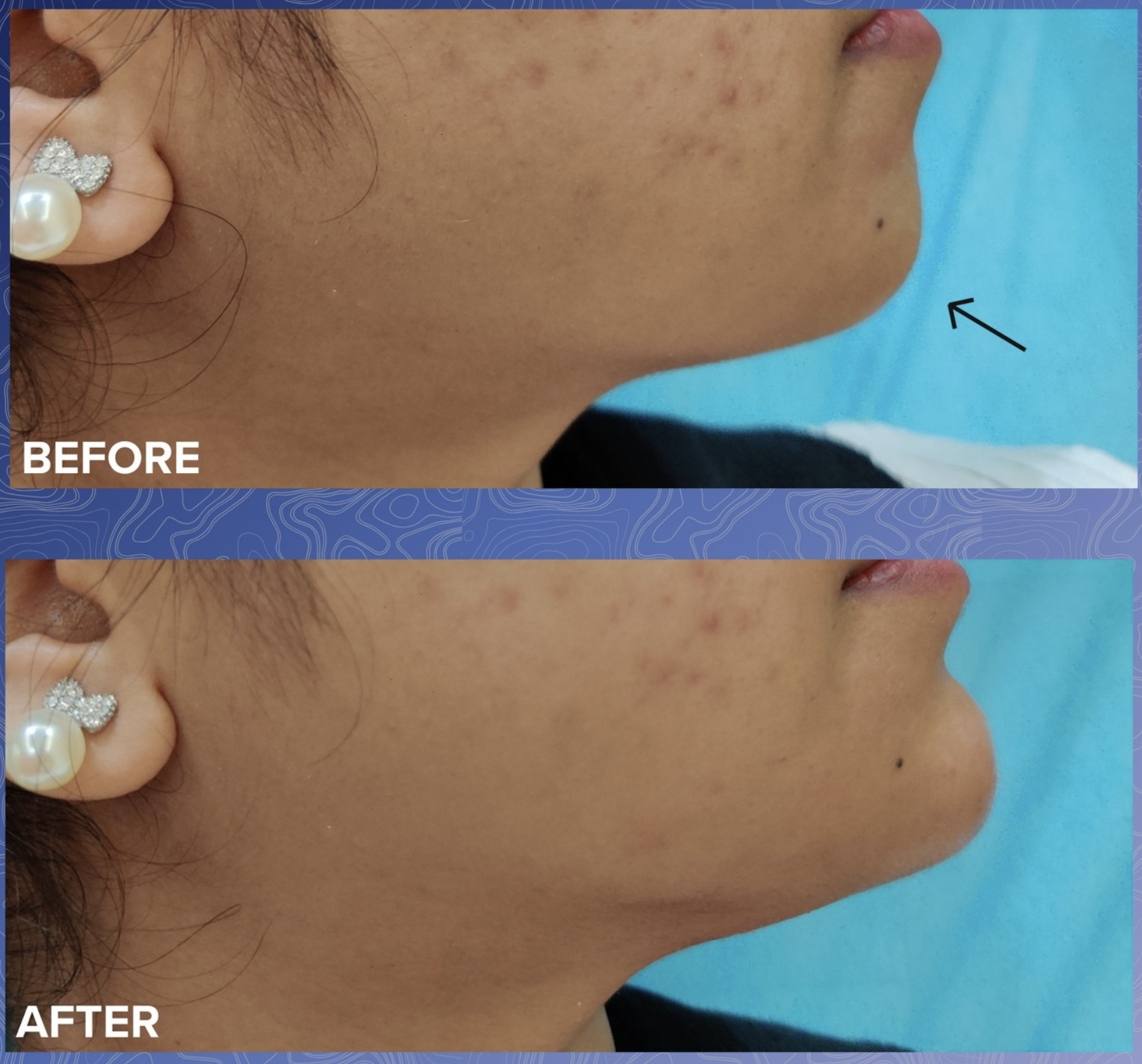 Jawline Filler Before & After 2