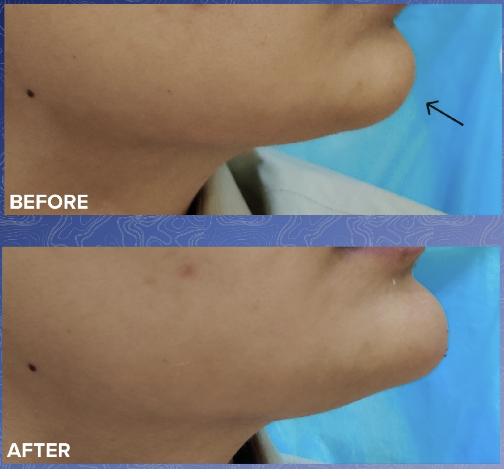 Jawline Filler Before & After 3