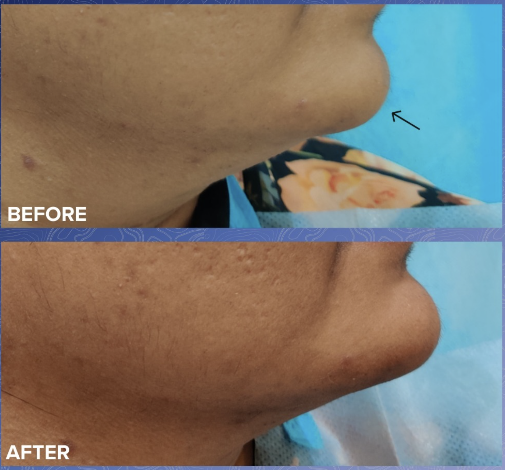 Jawline Filler Before & After 4