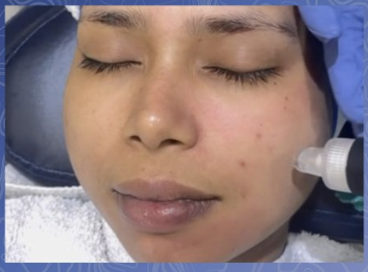 Hydra Facial Before & After 1
