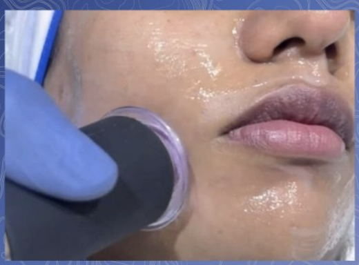 Hydra Facial Before & After 3