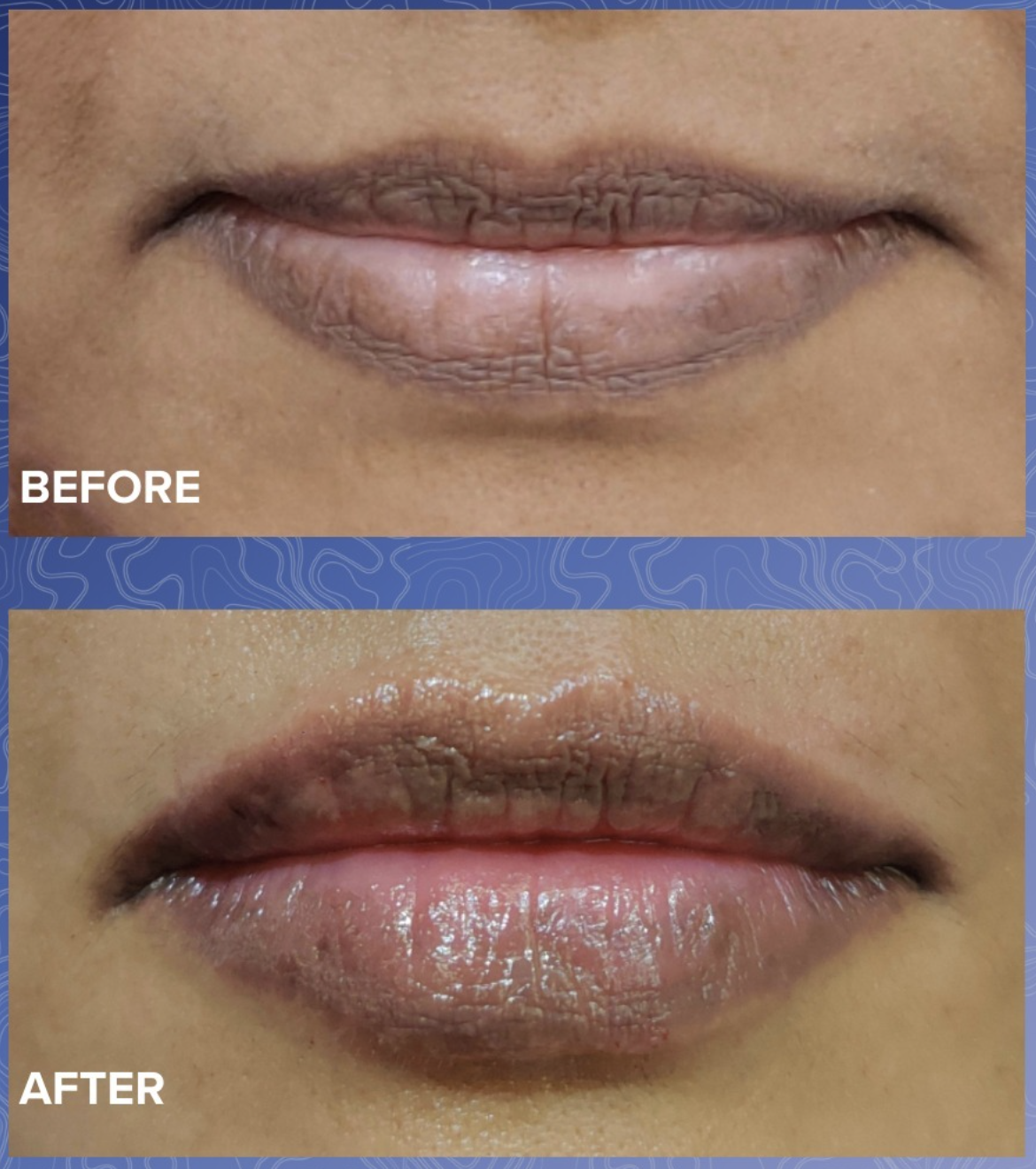 Lip Filler Before & After 1