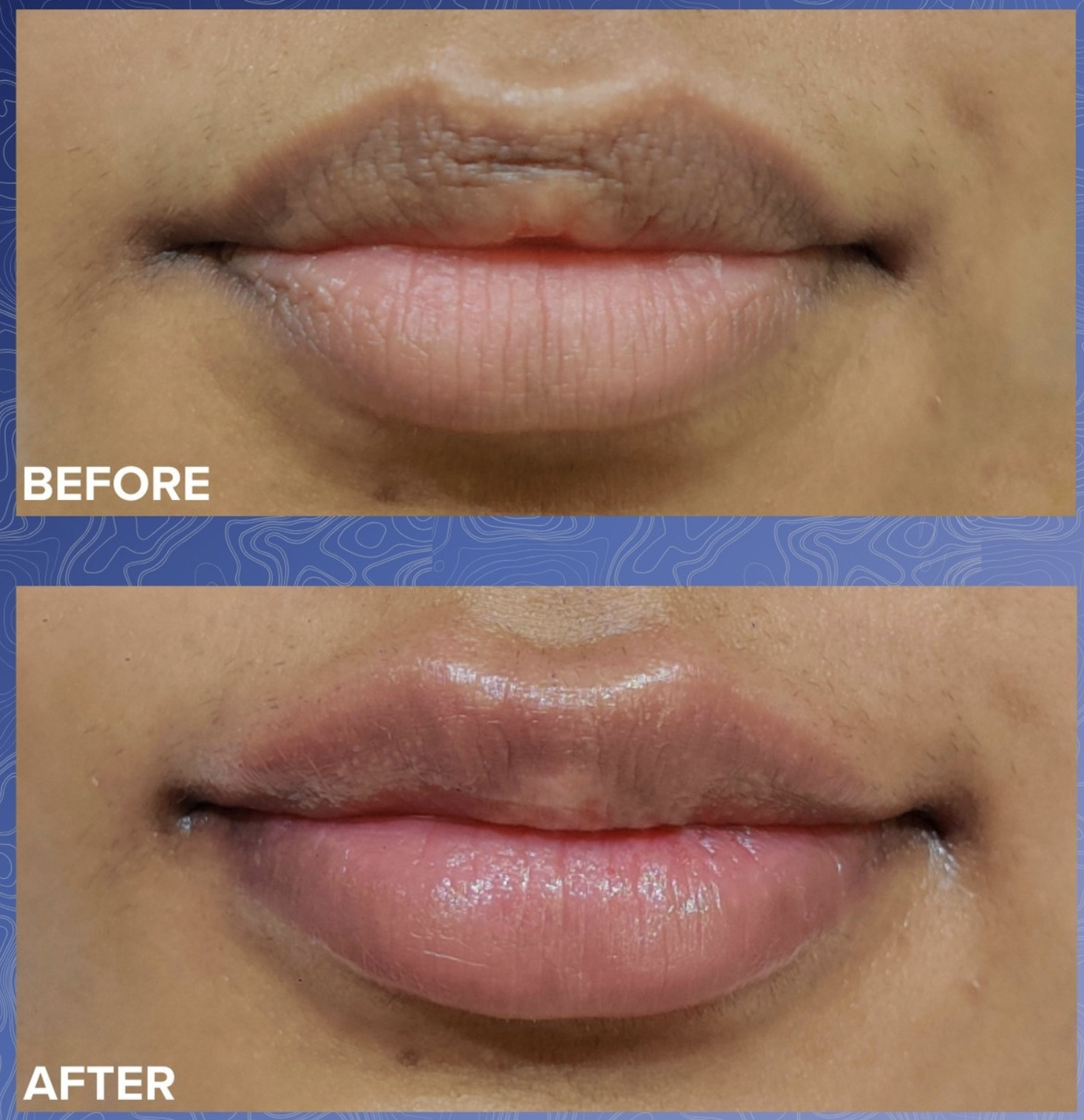 Lip Filler Before & After 2