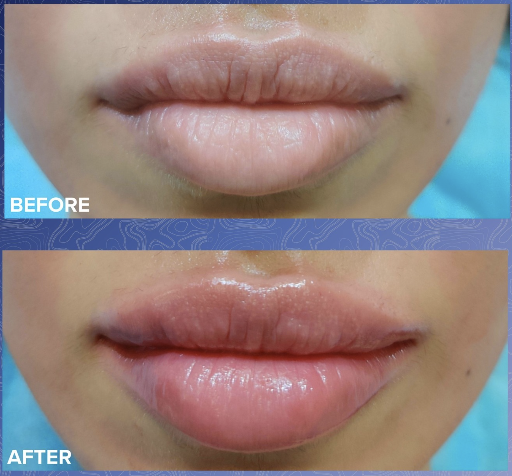 Lip Filler Before & After 3