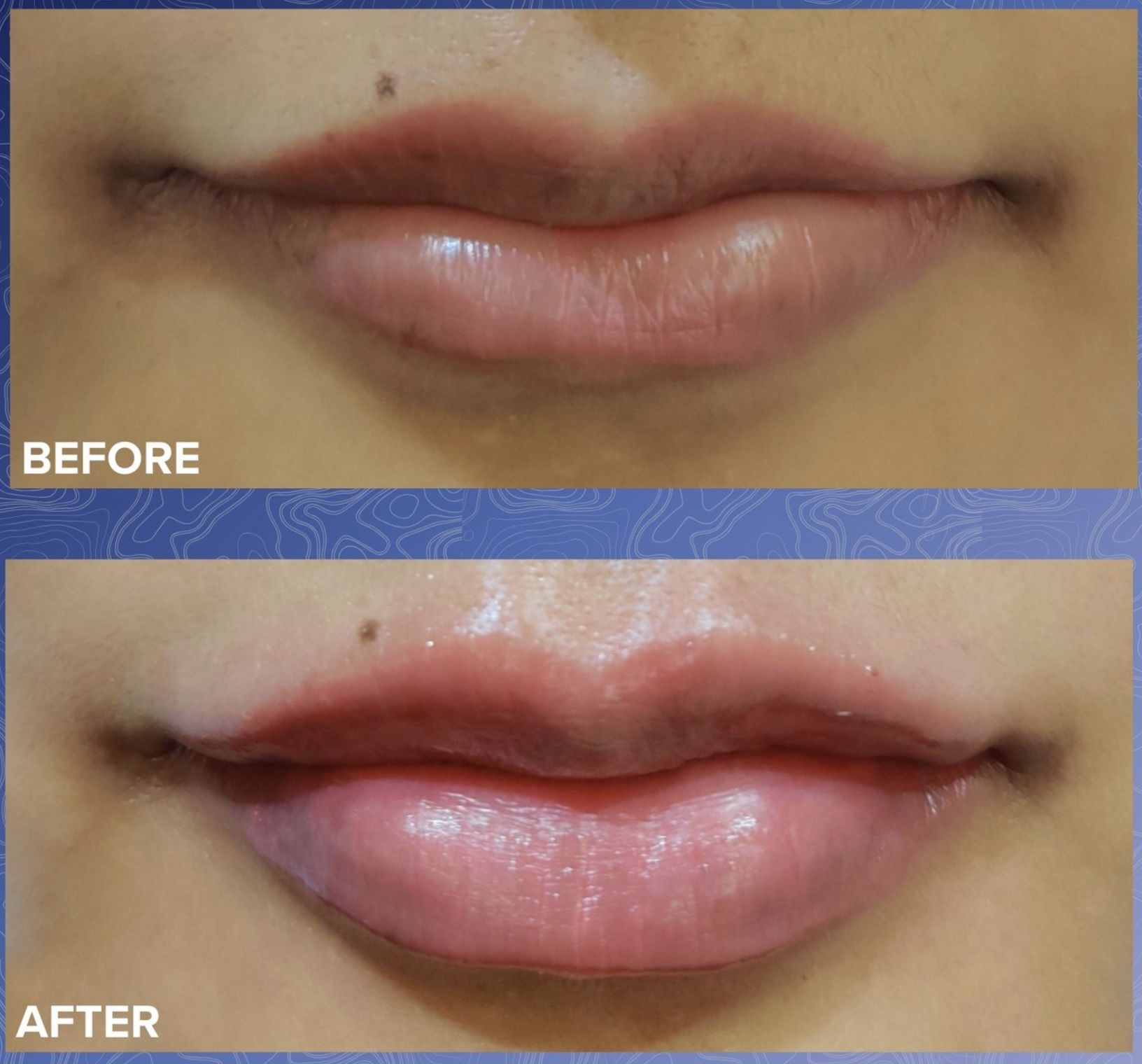 Lip Filler Before & After 4