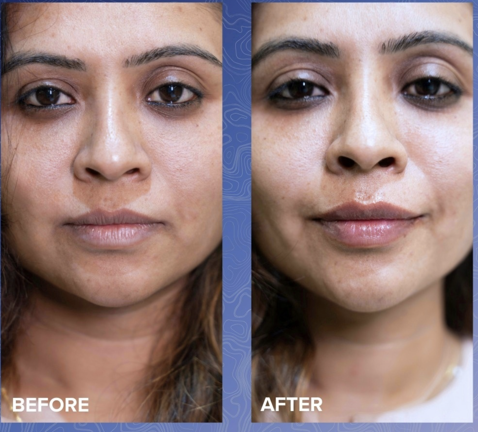 Lip Filler Before & After 5