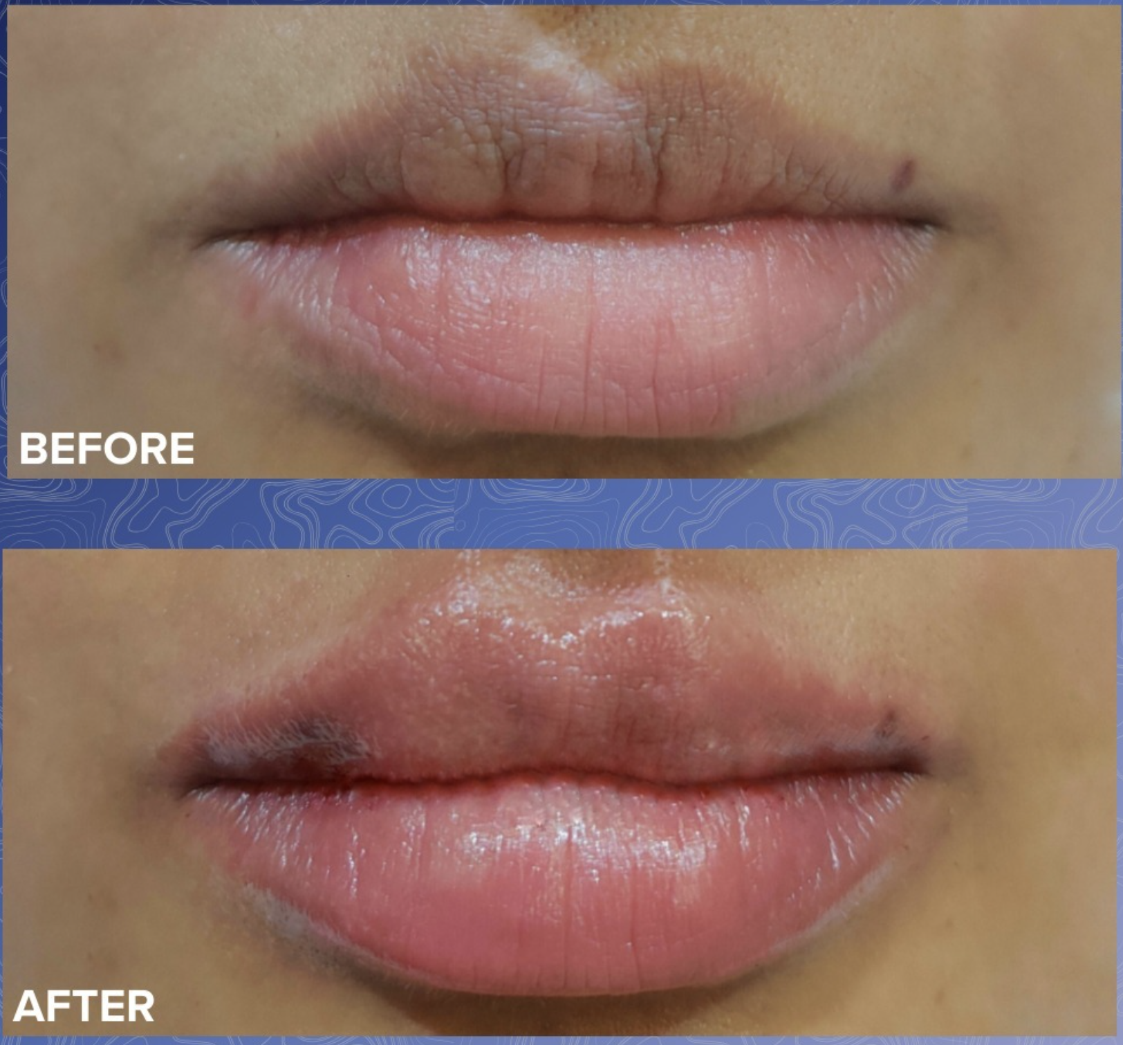 Lip Filler Before & After 6