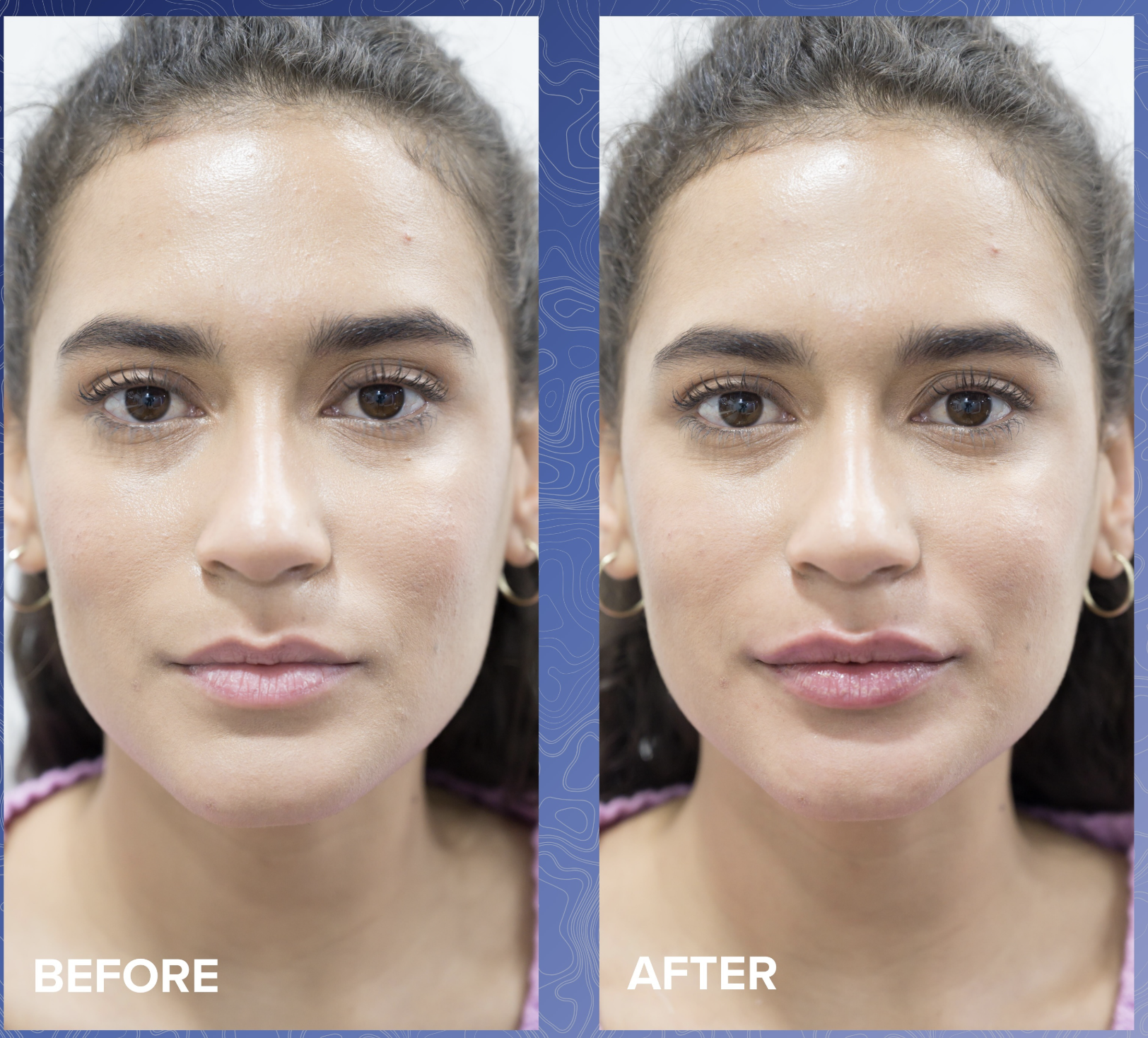 Lip Filler Before & After 7