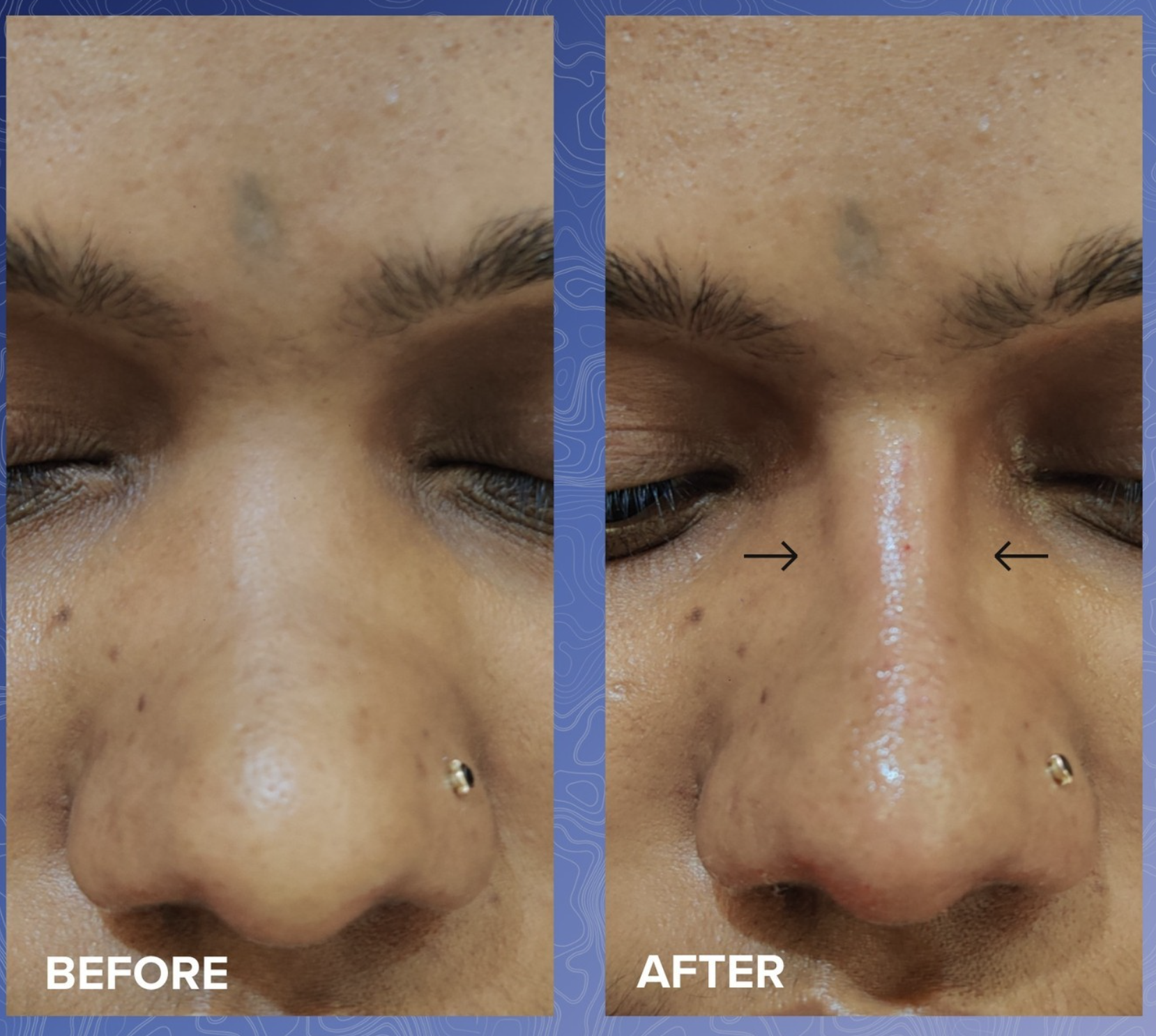 Non-Surgical Rhinoplasty Before & After 1