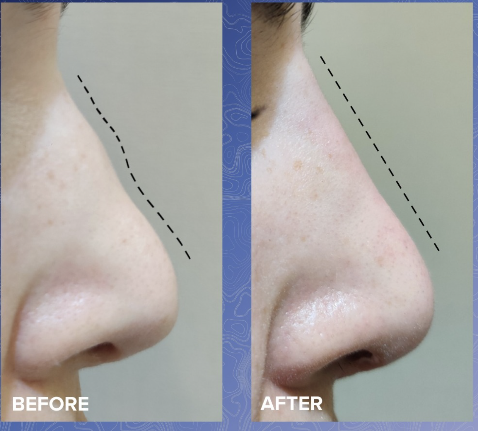 Non-Surgical Rhinoplasty Before & After 2