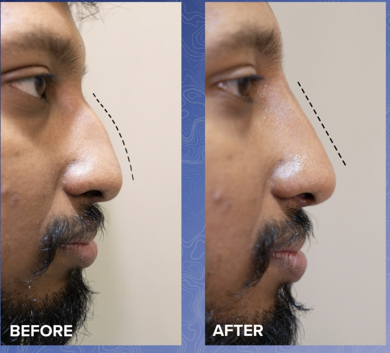 Non-Surgical Rhinoplasty Before & After 3