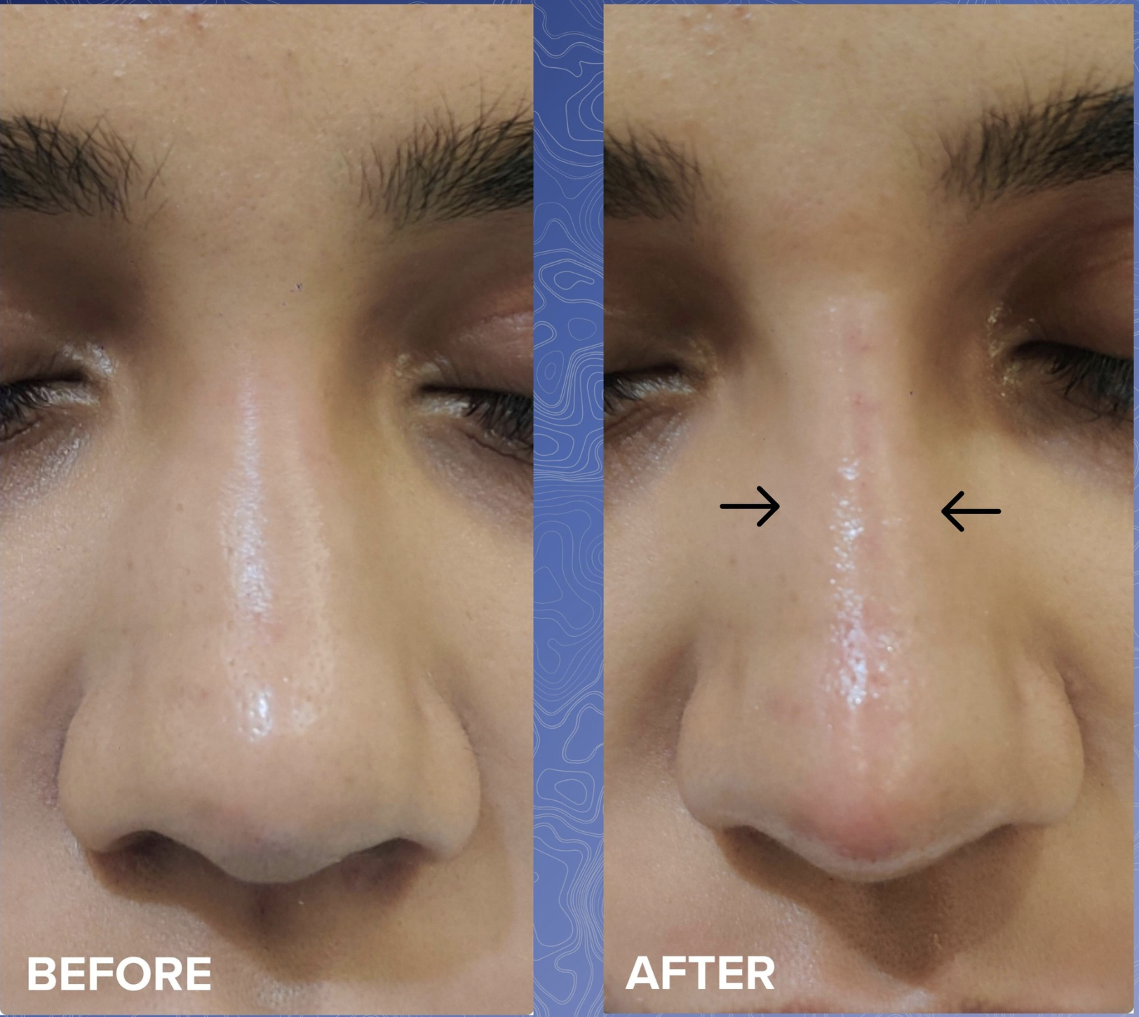 Non-Surgical Rhinoplasty Before & After 4