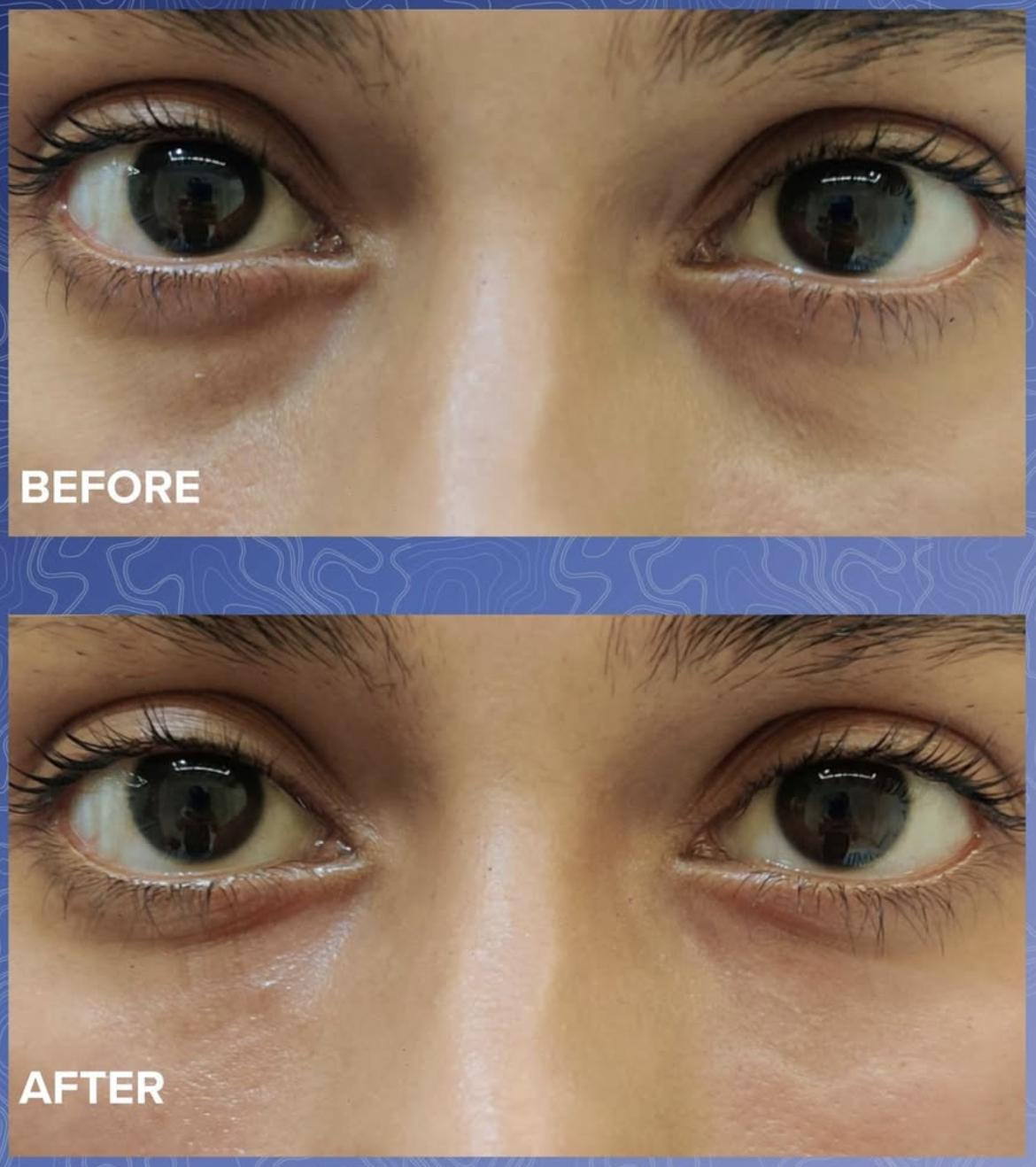 Undereye Filler Before & After 1