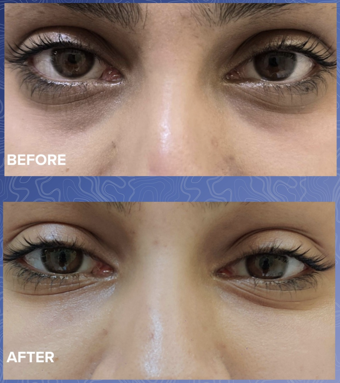 Undereye Filler Before & After 2