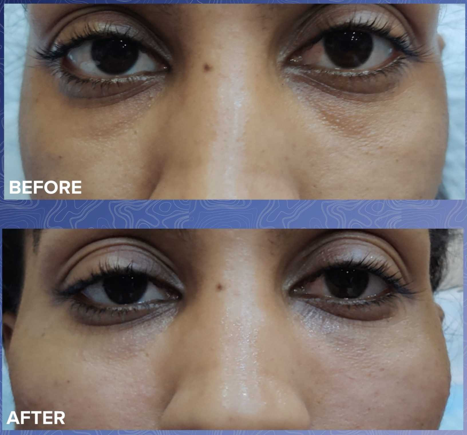 Undereye Filler Before & After 4